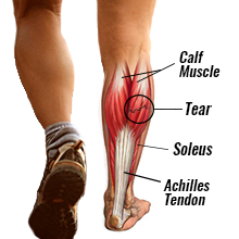 Endurocad - Injury Focus- Calf Strain A calf strain is an injury to the  muscles in the calf area (the back of the lower leg below the knee). The  calf muscle is